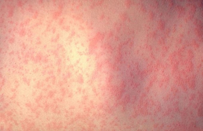  Институт Батут: Се шири епидемијата на мали сипаници во Смедерево