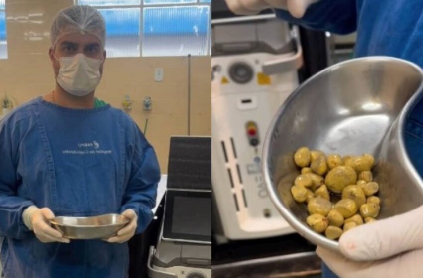  [ВИДЕО] Шок во операционата сала: Од бубрегот му извадиле 35 каменчиња – и тоа сè поради пијалокот кој е омилен на сите нас