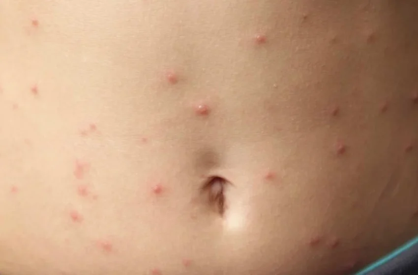  САД: Епидемијата на сипаници во Јужна Каролина продолжува да се шири